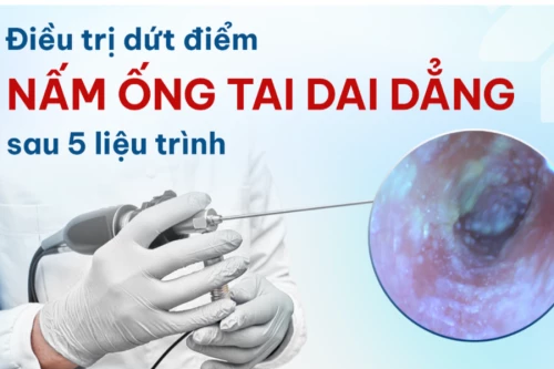 Điều trị dứt điểm tình trạng nhiễm nấm ống tai dai dẳng cho nam bệnh nhân sau 5 liệu trình